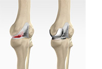 ACL Reconstruction 