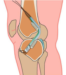 ACJ Reconstruction