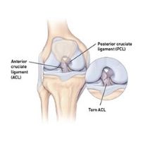 ACL Reconstruction