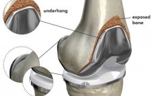 ACL Reconstruction