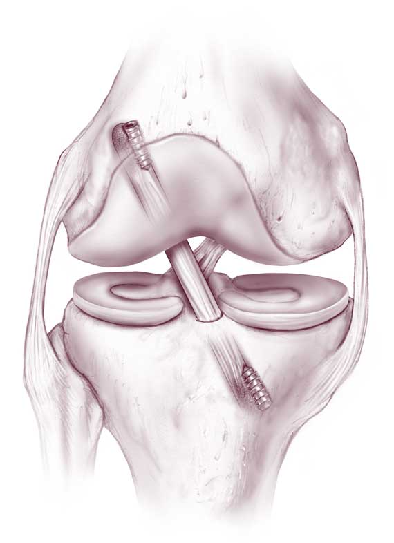 best ACL reconstruction in hyderabad