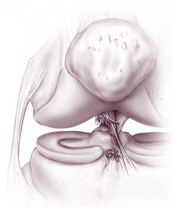 best ACL reconstruction in hyderabad