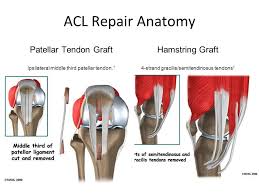 ACL Graft Choice