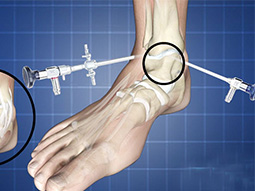 ANKLE ARTHROSCOPY