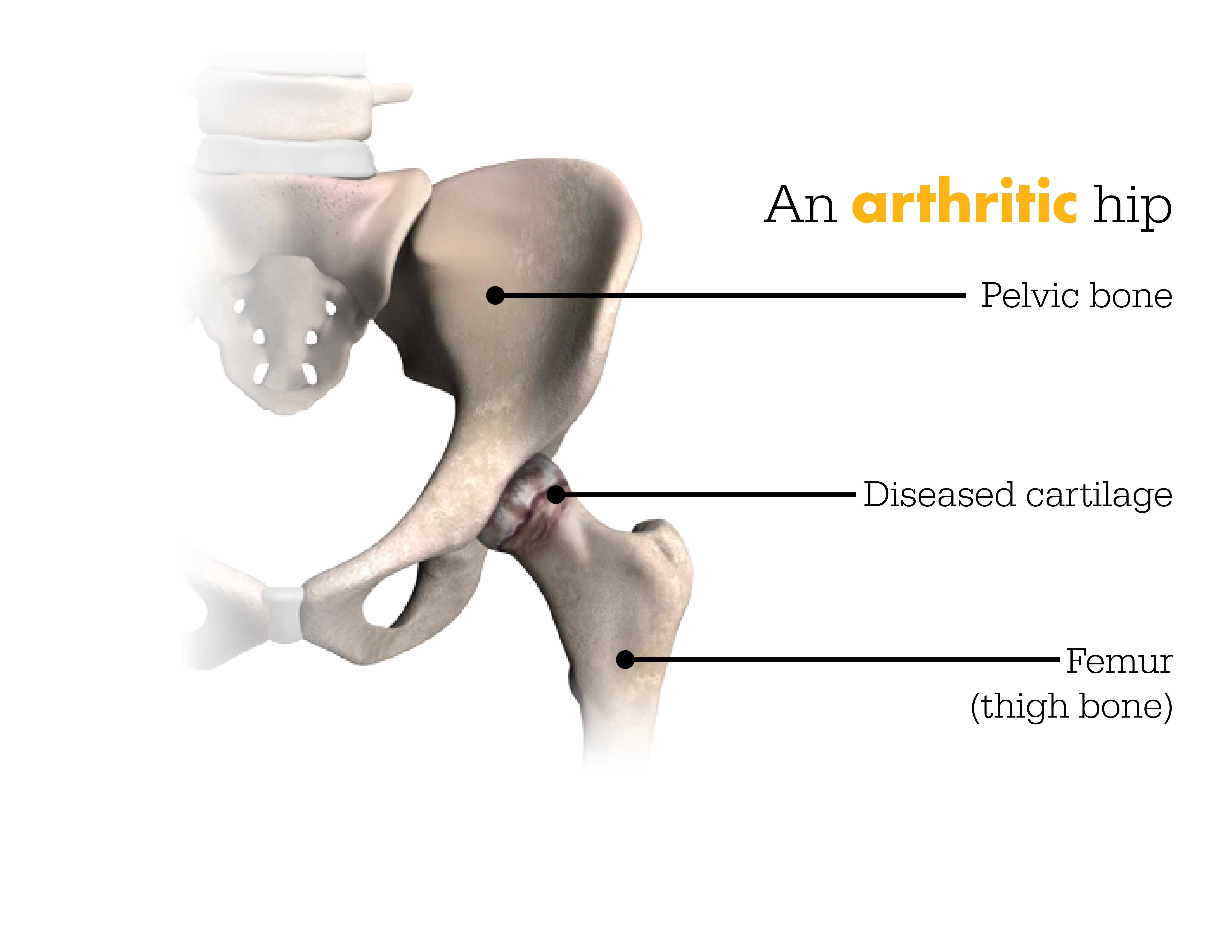 ACL Reconstruction