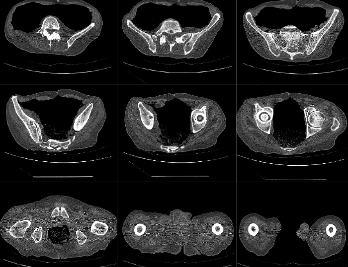 ACL Reconstruction