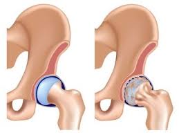 ACL Reconstruction