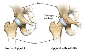 ACL Reconstruction