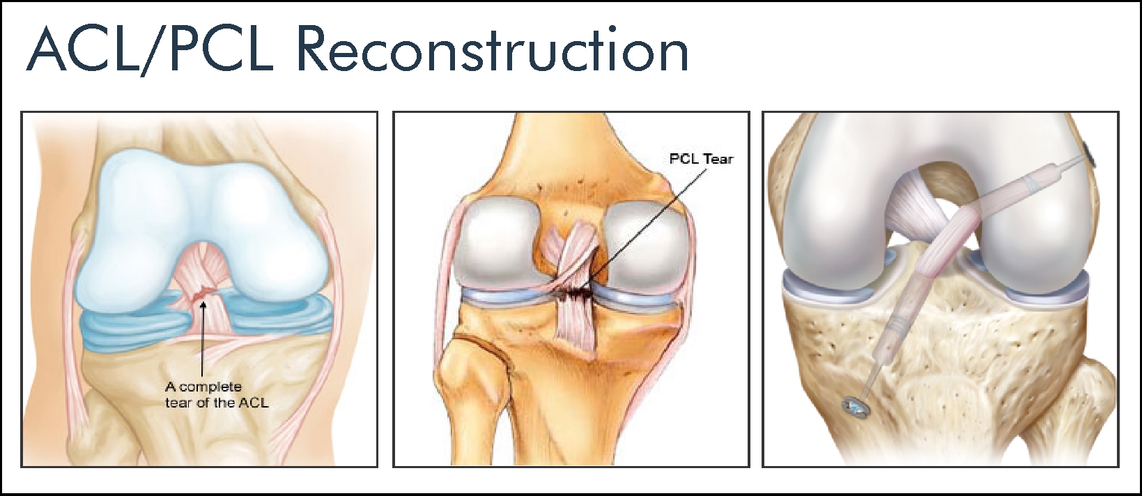 ACL/PCL arthroscopy