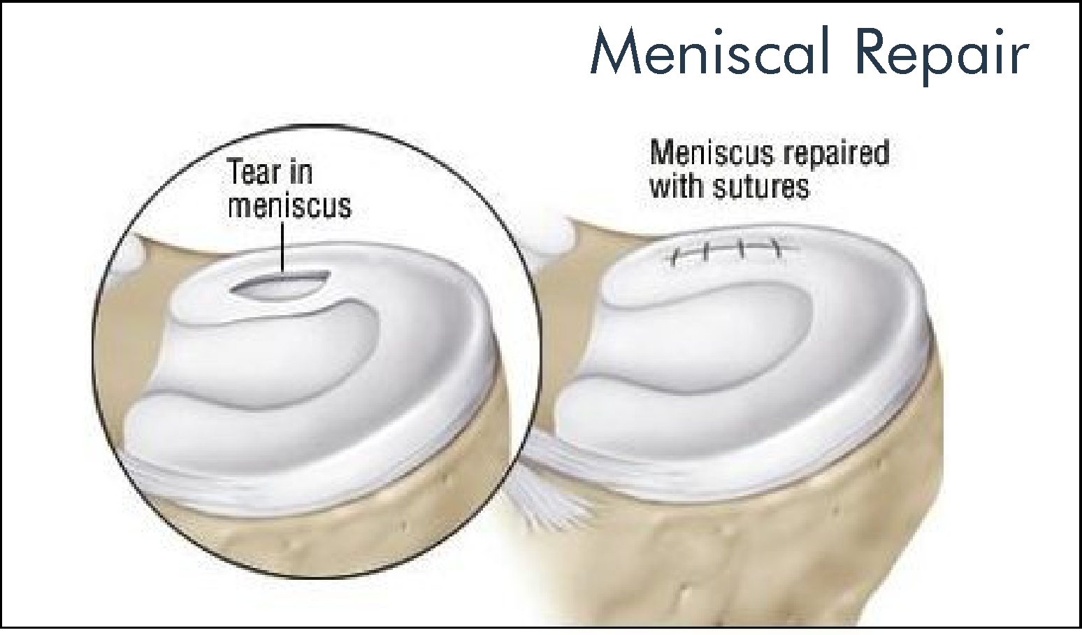 meniscal repair