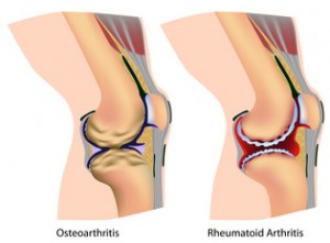 ACL Reconstruction