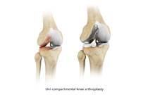 ACL Reconstruction