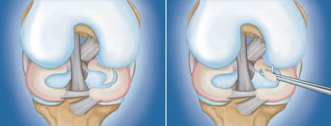 ACL Reconstruction