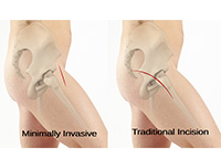 ACL Reconstruction