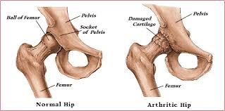 ACL Reconstruction