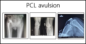 PCL avulsion