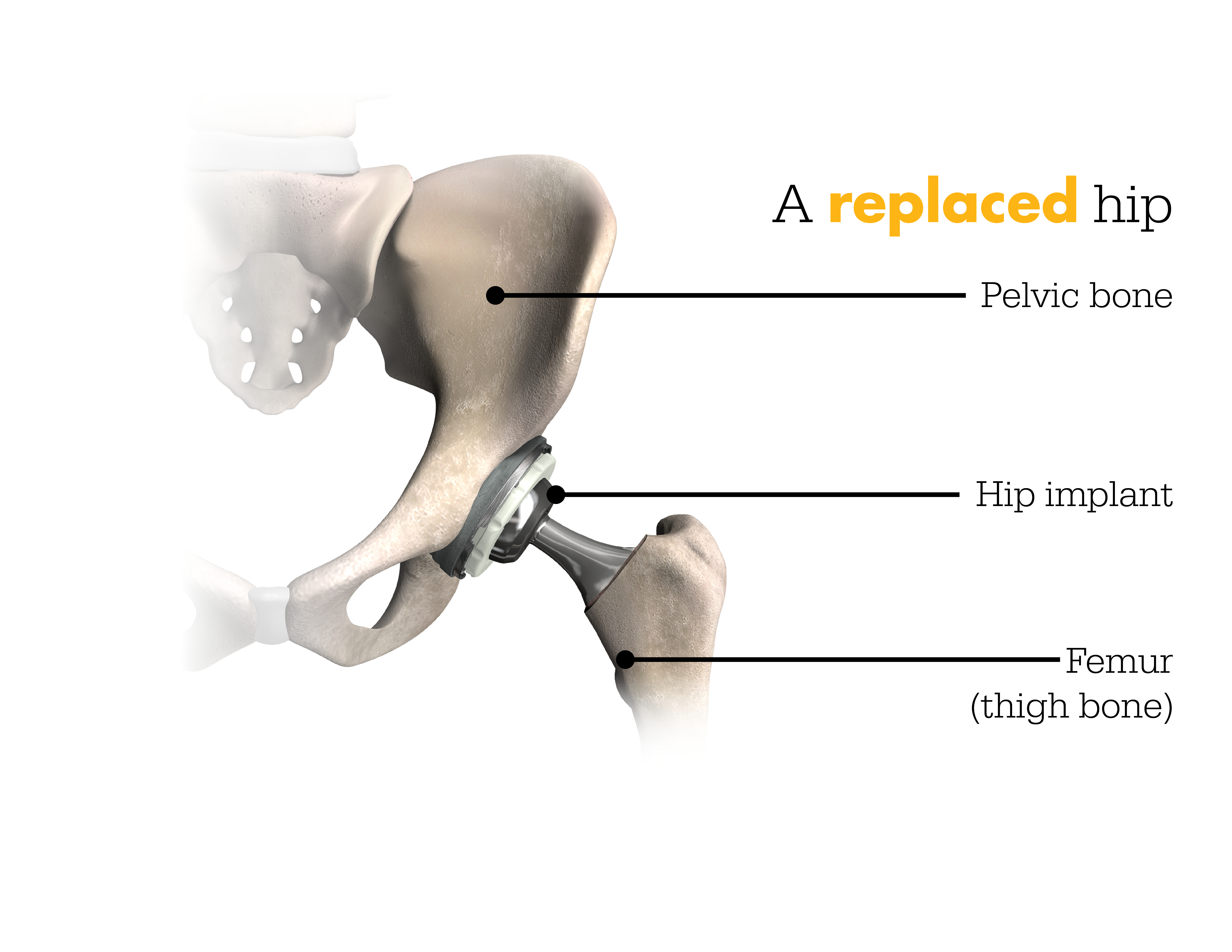 ACL Reconstruction