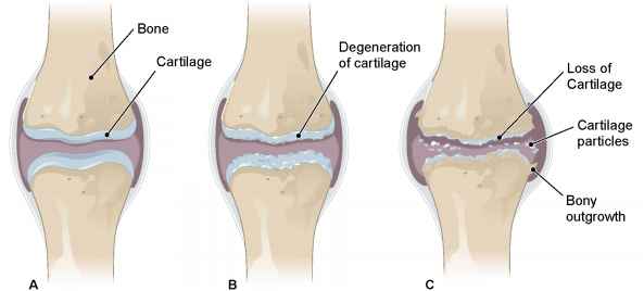 ACL Reconstruction