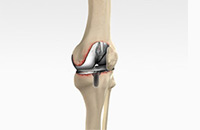 ACL Reconstruction