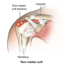 ACL Reconstruction