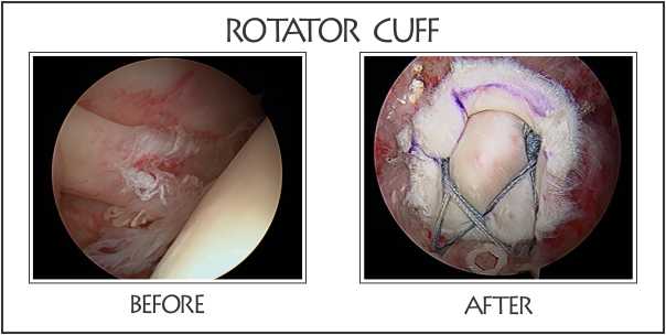 rotator cuff