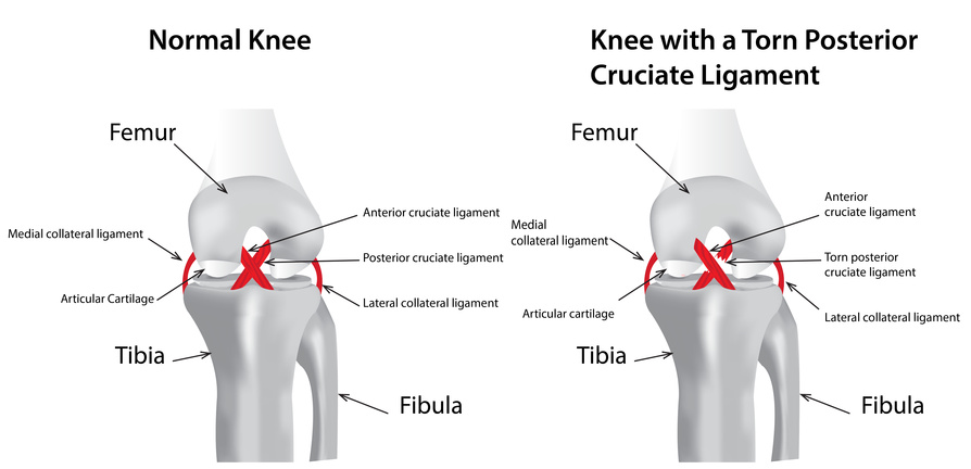 ACL Reconstruction