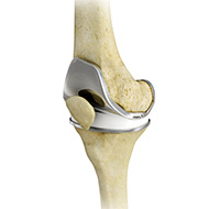 ACL Reconstruction