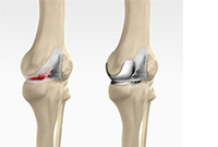 ACL Reconstruction