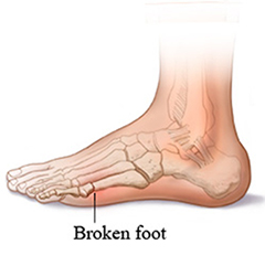 Foot Fracture