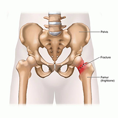 Hip Fracture